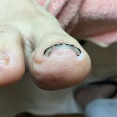 矯正後