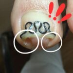 【巻き爪】食い込みの跡