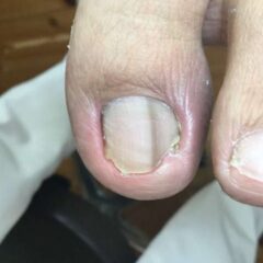 矯正前