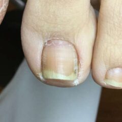 矯正前