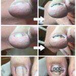 【巻き爪】ビフォーアフター写真
