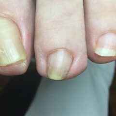 矯正前