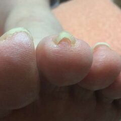 矯正前