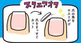 巻き爪矯正後に意識したいスクエアオフの爪の切り方