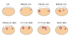正常な爪と軽度・中度・重度など巻き方の違いを示した巻き爪分類図