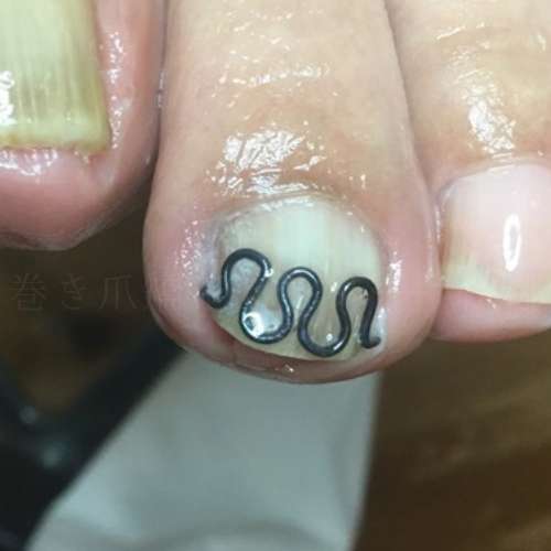人差し指巻き爪の真上アングル：矯正後、巻き込んで細くなっていた爪幅が本来の広さに戻った比較写真