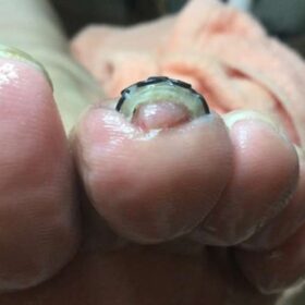 左足人差し指の巻き爪矯正後の正面写真：皮膚への食い込みが和らぎ本来の形に整った変化