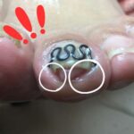 左足人差し指の巻き爪矯正後の写真：皮膚への食い込みの強さがわかる跡