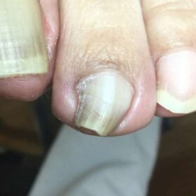 左足人差し指の巻き爪：矯正前真上アングル