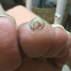 左足人差し指の巻き爪：矯正前正面写真