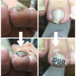 左足人差し指の巻き爪矯正ビフォーアフター写真：皮膚への食い込みが和らぎ本来の形に整った変化