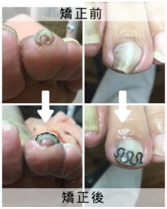 左足人差し指の巻き爪矯正ビフォーアフター写真：皮膚への食い込みが和らぎ本来の形に整った変化