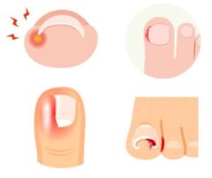 足の爪の周囲に赤みや腫れが見られる状態のイラスト