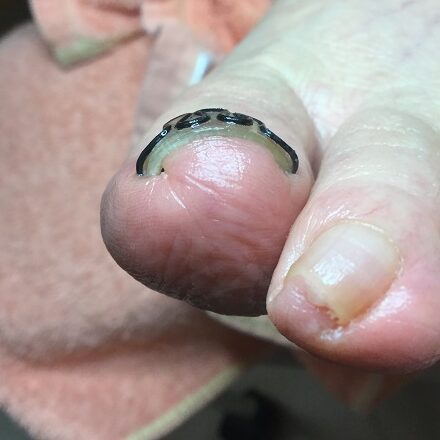 矯正後