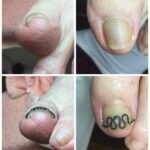 【巻き爪】ビフォーアフター写真