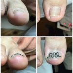 【巻き爪】ビフォーアフター写真