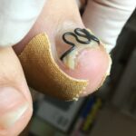 皮膚に埋まっていた爪